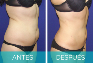 presoterapia antes y despues abdomen